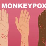 monkeypox-rash-illustration