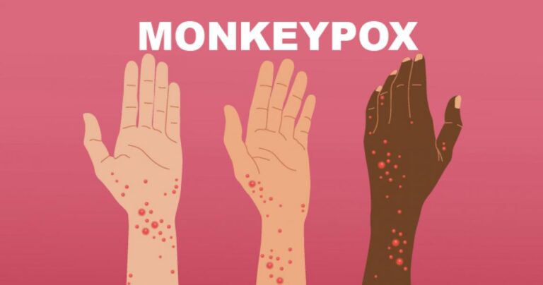 monkeypox-rash-illustration